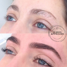 brow correction before and after